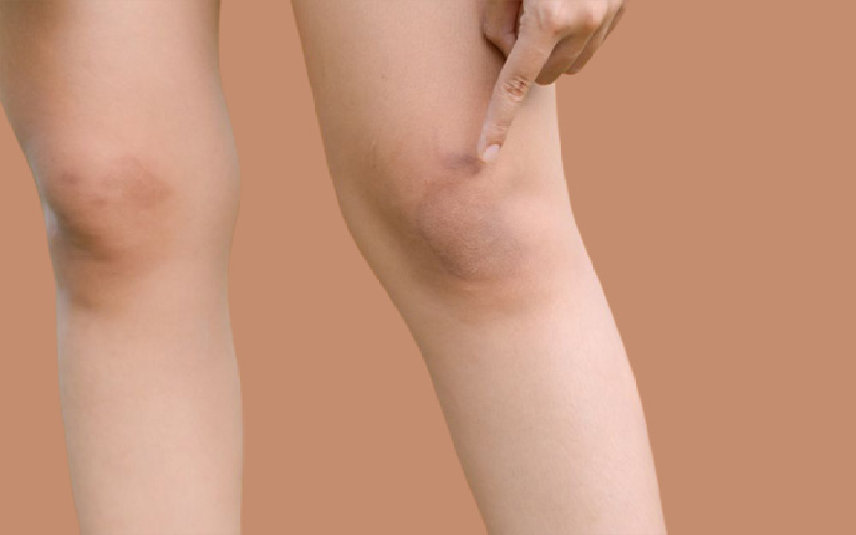 8 Cara Alami Membersihkan Lutut yang Menghitam, Jangan Bikin Malu!