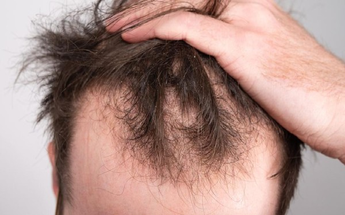 5 Tips Mengatasi Permasalahan Rambut Rontok Pada Pria, Ampuh Banget Ternyata!