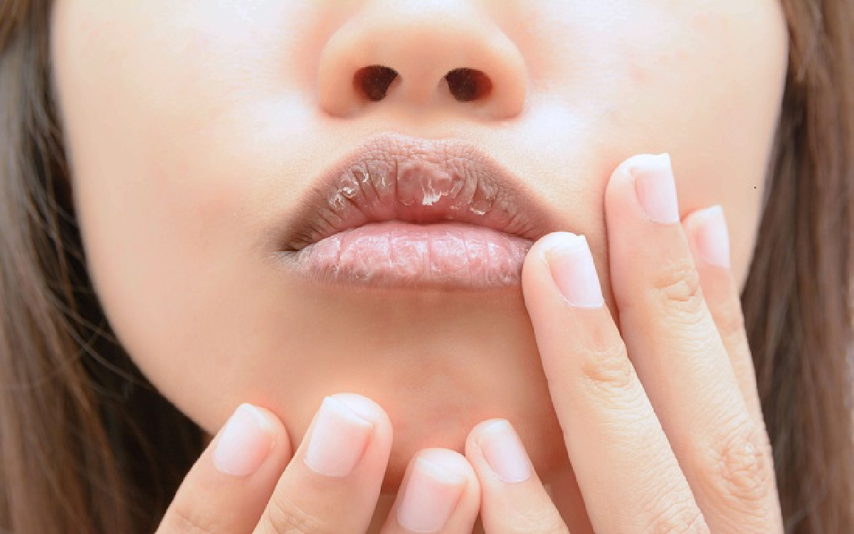 Bibir Kering dan Pecah-Pecah Saat Berpuasa? Ketahui Penyebab dan Cara Mengatasinya