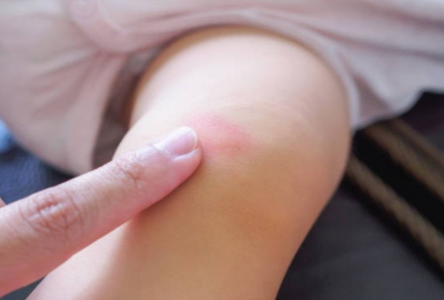 6 Cara Cepat Hilangkan Bekas Gigitan Nyamuk di Kulit Bayi, Totol Merah Auto Lenyap