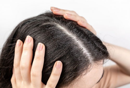 10 Cara Menghilangkan Ketombe Bandel di Rambut Cukup dengan Bahan Alami, Pasti Langsung Lenyap!