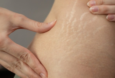 5 Cara Mudah Penghilang Stretch Mark Pakai Bahan Alami, Kulit Auto Mulus Lagi